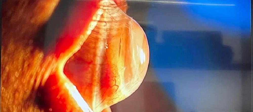 Queratocono: Una guía completa para entender tus ojos